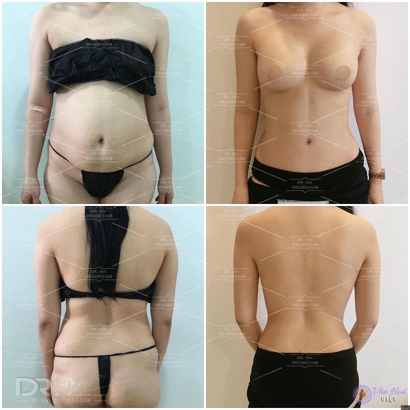Hình ảnh trước và sau khi phẫu thuật hút mỡ tạo hình lại rốn