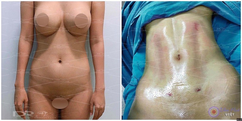 Hình ảnh trước và sau khi phẫu thuật hút mỡ và tạo cơ