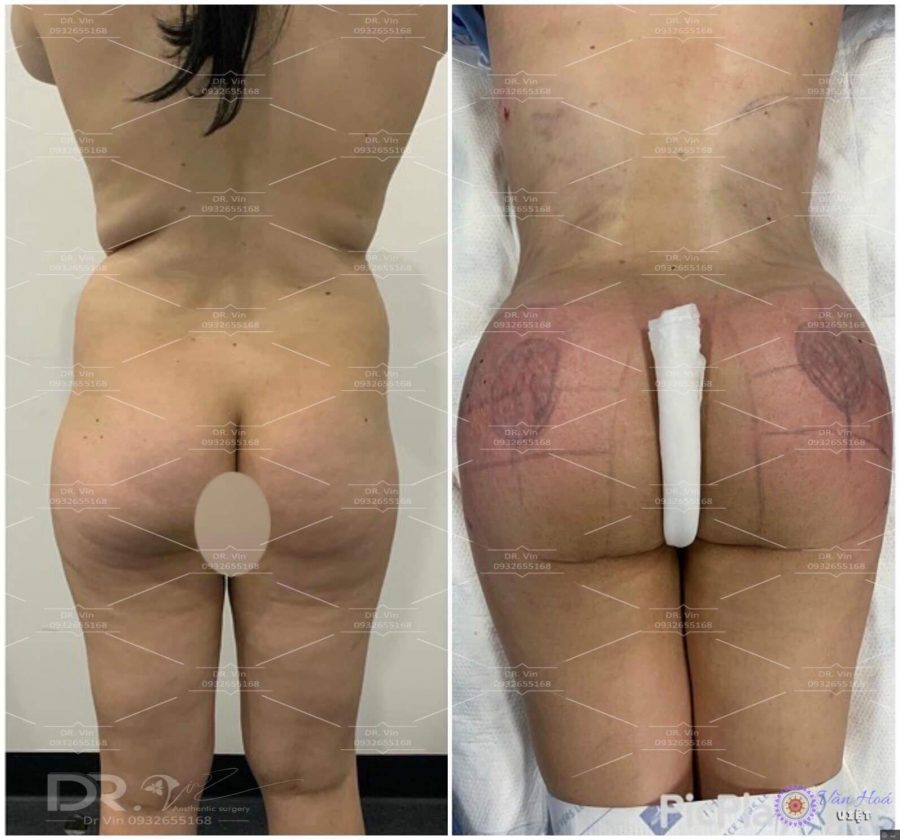 Hình ảnh trước và sau khi phẫu thuật hút mỡ và cấy mỡ