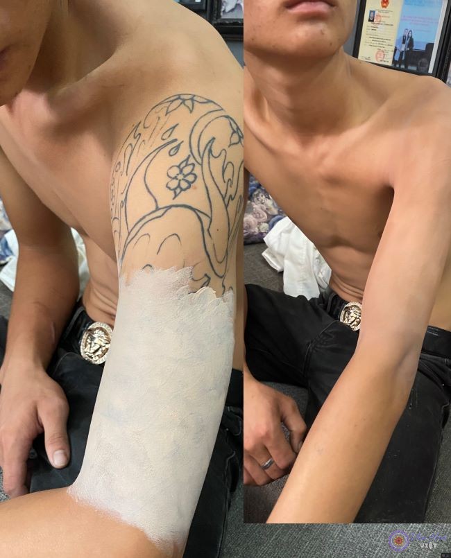 Trước và sau khi sử dụng kem che xăm Võ Long Tâm